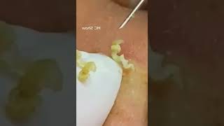 Pickel Ausdrücken Blackheads Akne amp Mitesser entfernen 🔴 7 [upl. by Laflam]