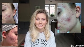 HOE ben ik van mijn acne afgekomen Tips amp mijn ervaring [upl. by Natsirt225]