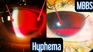 Injury to the eye Hyphema medicine mbbs neetpg usmle inicet neet aiims ophthalmology [upl. by Ardnassela]