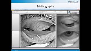 Online Seminar Chad Overman Tips for Practice Building with Your Keratograph® 5M [upl. by Nirrep533]