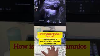 Reduced Liqour amnii during pregnancy What to doDr Sunil Kumar G Samnioticfluid amniocentesis [upl. by Naamann]