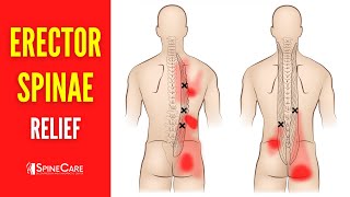 How to Fix Erector Spinae Pain FOR GOOD [upl. by Krystal251]