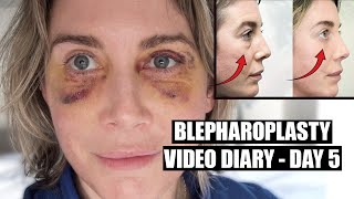 Blepharoplasty Video Diary  Day 5 After Surgery 4 of 15 [upl. by Richmal]