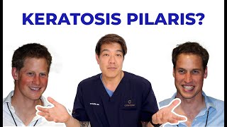 Keratosis Pilaris  How to treat by dermatologist Dr Davin Lim [upl. by Annoel]