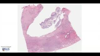 Lung abscess virtual microscopy  Talking slide [upl. by Ataynek303]