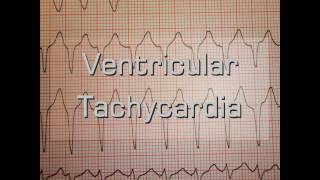 Ventricular Tachycardia [upl. by Lraep249]