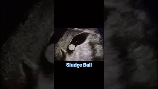 Sludge Ballabdomen baby usg doctor pediatrician pianolovesongs nature music piano [upl. by Ephram]