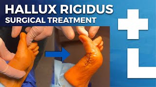 Hallux rigidus surgery  cheilectomy Moberg osteotomy  Dworska hospital® [upl. by Harlow]