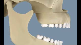 Alignement chirurgical dentaire  Chirurgie Orthognatique [upl. by Mohkos]