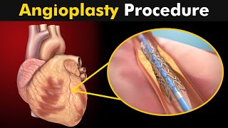 How Angioplasty Procedure is performed [upl. by Attelrahs]