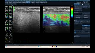 IQ 305 LIVER ULTRASOUND ECHOPAC ANALYSIS HEPATOMA ELASTOGRAPHY [upl. by Walliw]