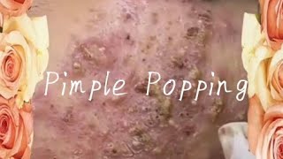 Pimple amp Blackheads Popping  8 [upl. by Anirbas611]