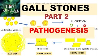 CHOLELITHIASIS GALL STONESPart 2 Pathogenesis Morphology Clinical FeaturesComplications [upl. by Akemot573]