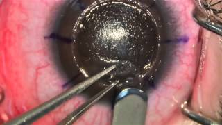 Anterior Lamellar Keratoplasty [upl. by Ginder]