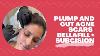 PLUMP AND CUT ACNE SCARS  BELLAFILL  SUBCISION  Dr Jason Emer [upl. by Eelir]