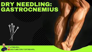 Dry Needling Gastrocnemius [upl. by Cherlyn]