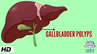 Gallbladder Polyp Causes Signs and Symptoms Diagnosis and Treatment [upl. by Alyar]