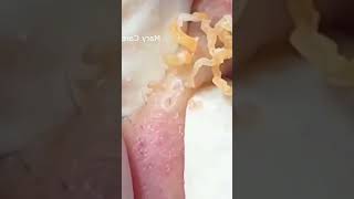 Pickel Ausdrücken Blackheads Mitesser entfernen 🔴 50 [upl. by Cristen]