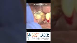 Grossly decayed molar extraction in 30 sec [upl. by Enomad861]