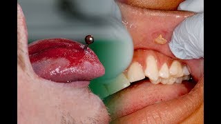 The Problem with Tongue Piercings 👅 Risks Complications Tips [upl. by Mortimer768]