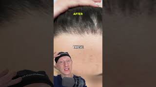 How I Got An INCREDIBLE Hairline Lowering Result [upl. by Acitel]