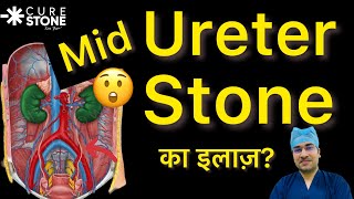 MidUreteral Stones  स्टोन का इलाज क्या है  Treatment for Kidney Stones in MidUreter [upl. by Aynot]