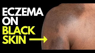 Doctor explains what ECZEMA looks like on BLACK SKIN  plus photos diagnosis and treatment [upl. by Assyram]