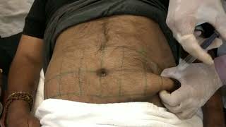 Lipodissolve Injection Technique for PeriAbdominal Fat  ILAMED [upl. by Forster]