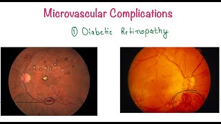 Diabetes Mellitus Part 3 B Microvascular Complications [upl. by Akener]