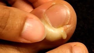 Paronychia What Are Nail Infections [upl. by Nettirb]