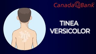 Tinea Versicolor [upl. by Binnings]