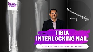 Tibia Interlocking Nail Complete Procedure [upl. by Dewhurst661]