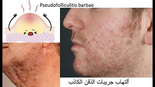 pseudofolliculitis barbae التهاب جريبات الذقن الكاذب [upl. by Boony]