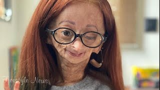 YouTube star Adalia Rose from Texas dies at 15 [upl. by Tergram633]