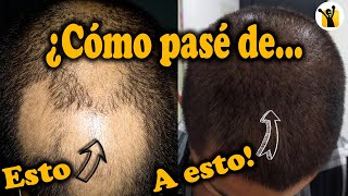 ¿Como CURAR la ALOPECIA AREATA  Mi experiencia  ¿Minoxidil ¿Inyecciones ¿Remedios caseros [upl. by Nannek833]