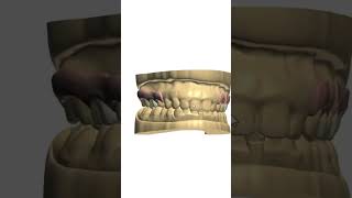 Flexible Denture Design dentist [upl. by Honig]