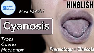 Cyanosis  Types Causes amp Mechanism  Physiology  Clinicals  MBBS Mentor [upl. by Sone820]