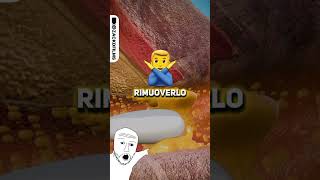 COME RIMUOVERE IL CERUME IN MODO CORRETTO👂🏻✅ credits zackdfilms   shorts curiosita [upl. by Elkin447]