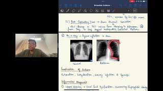 BRONCHIAL ASTHMA For University Studentsl Dr Sahil Bansal [upl. by Croix]