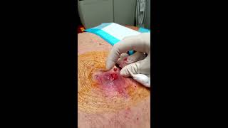 HD Graphic Step by Step Abscess and Infected Lipoma Drainage Medical Education amp Training [upl. by Limak]