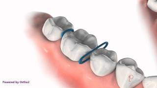 Orthodontic Spacers [upl. by Edwards]