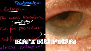 What is Entropion  And it’s types  signs and symptoms  and treatment explained in very easy words [upl. by Miza]