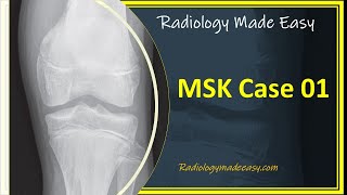 FRCR Radiology MSK Case 01  A 13 yrs old boy presented with pain in the left lower limb [upl. by Drofkcor]