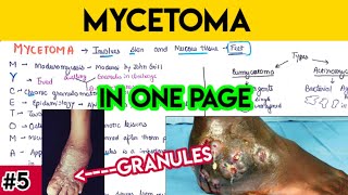 Mycetoma explained in simplified way with mnemonic 🤯  mycology microbiology MCWA [upl. by Yduj479]