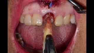 Ridge preservation and delayed implant placement in esthestic area [upl. by Mei]