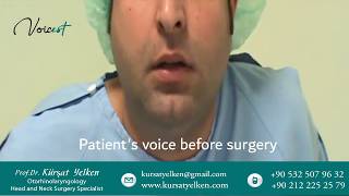 Voice Masculinization Surgery Voice Deepening Surgery [upl. by Bink352]