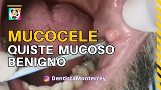 MUCOCELE 👅 QUISTE MUCOSO BENIGNO dental [upl. by Arriet]