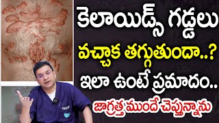 Dr Movva Srinivas  What is the best treatment for Keloid in young people  Dr MOvva [upl. by Neri]