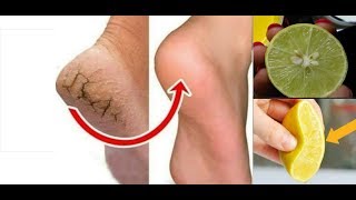 1 ही दिन में फटी एड़िया से छुटकारा पाए Cracked Heels Home Remedy  Cracked Heels Treatment [upl. by Handel]