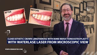 lose esthetic crown lengthening with bone reductionossteoplasty with waterlase laser [upl. by Enalahs]